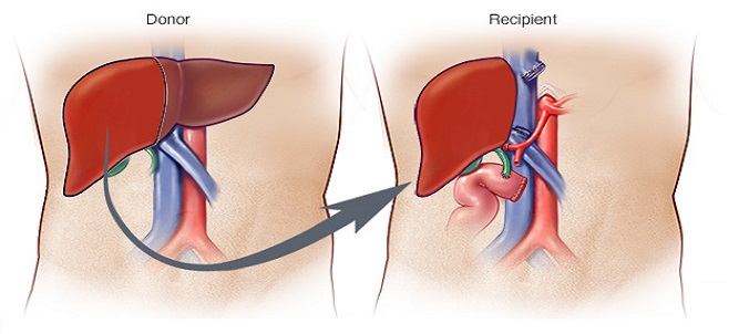 Liver Transplantation