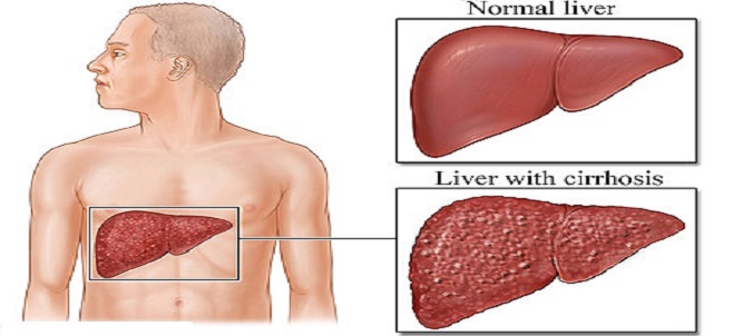 Cirrhosis