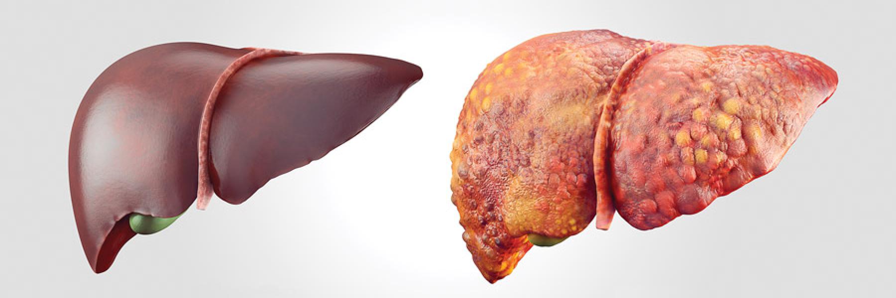 Type of Liver Hepatitis, Acute Hepatitis, Chronic Hepatitis | Dr. Naimish  Mehta