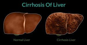 Cirrhosis-Of-Liver