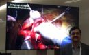 open heart surgery video